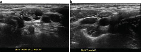 4,19 Reported <b>size</b> criteria are variable; however, it has been shown that <b>normal</b> <b>nodes</b> have a short- to long-axis ratio of less than 0. . Normal size of lymph nodes in neck ultrasound